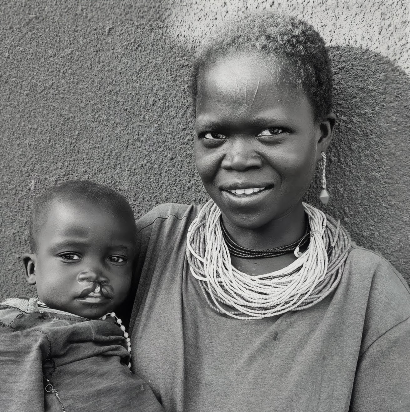 Upasuaji International community health work in East Africa
